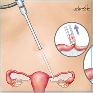 روش بستن لوله های رحمی با لاپاراسکوپی 