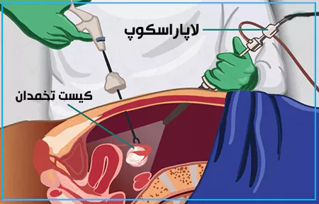 جراحی لاپاراسکوپی کیست تخمدان چگونه انجام می شود؟