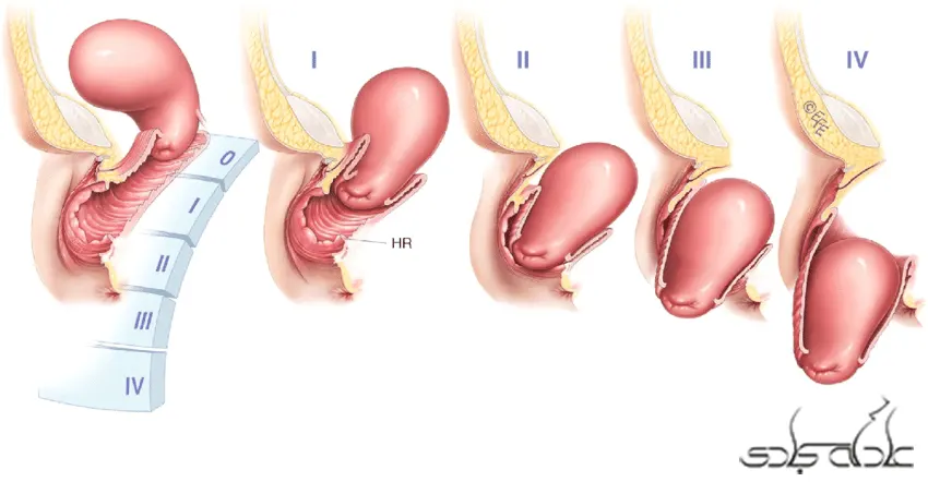مراحل افتادگی رحم